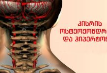 მოსახლეობის 90% კისრის ოსტეოქონდროზით იტანჯება. შეაჩერეთ თავის ტკივილი, გულისრევა, თავბრუსხვევა “კისერ-ცერებრალური თერაპიით”!